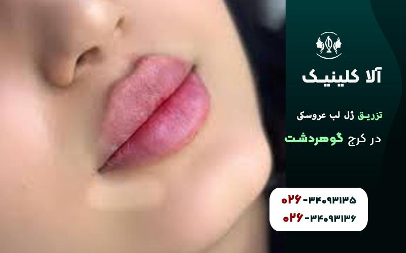 تزریق ژل لب مدل عروسکی در کرج