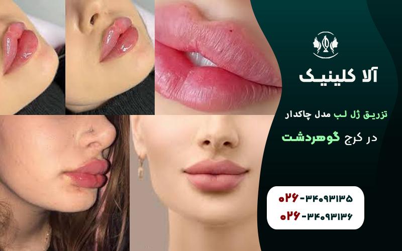 تزریق ژل لب مدل چاکدار
