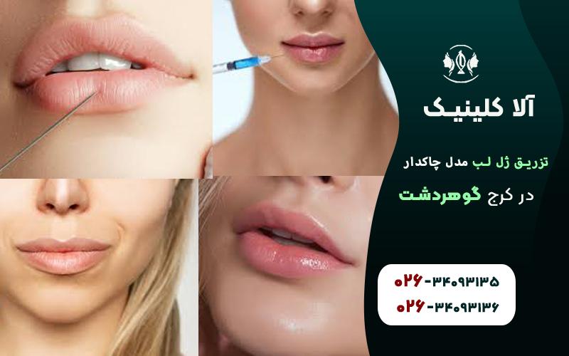 تزریق ژل لب مدل چاکدار