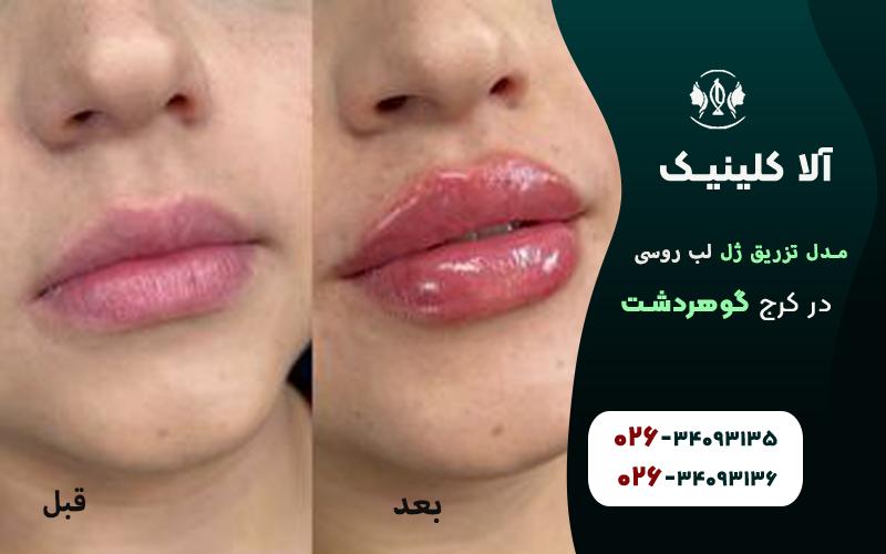 تصویر قبل و بعد از تزریق ژل لب روسی