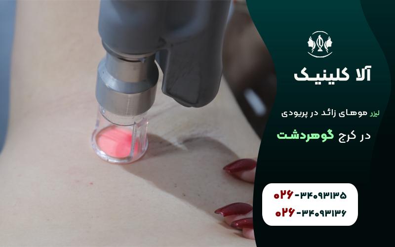 لیزر موهای زائد ذر هنگام پریودی