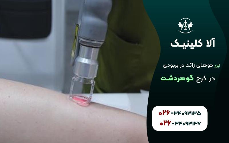 لیزر موهای زائد ذر هنگام پریودی