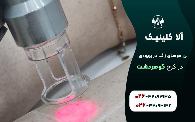 لیزر موهای زائد ذر هنگام پریودی