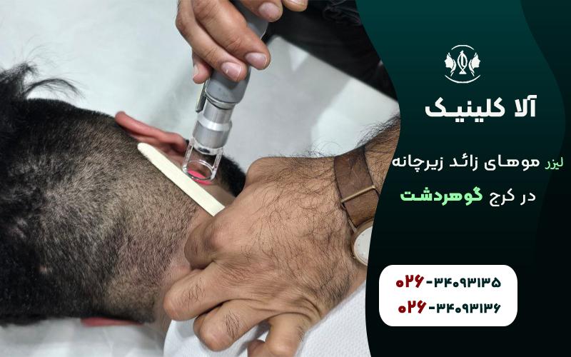 لیزر موهای زائد زیرچانه در کرج