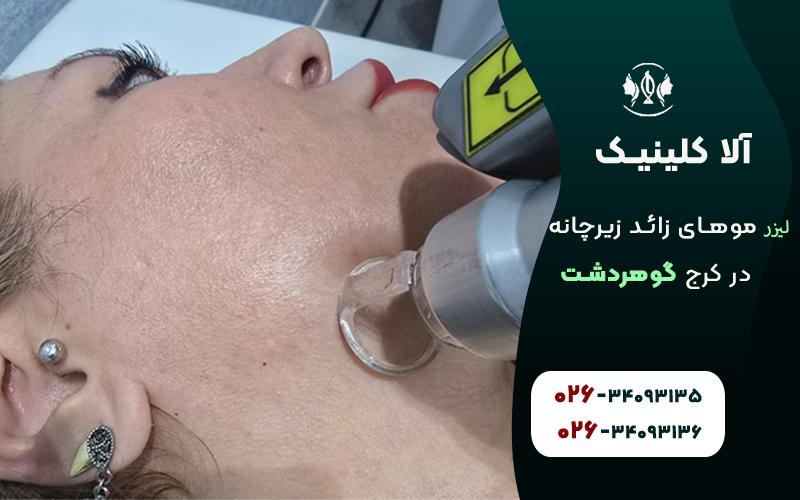 لیزر موهای زائد زیرچانه در کرج