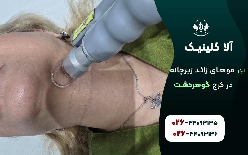 لیزر موهای زائد زیرچانه در کرج