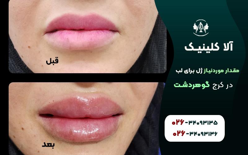 چند سی سی ژل برای تزریق لب مورد نیاز است؟