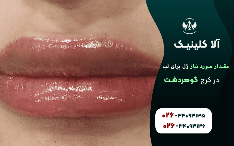 مقدار موردنیاز ژل برای تزریق لب