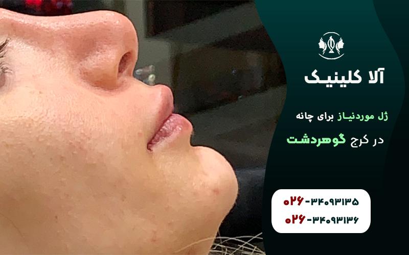 ژل موردنیاز برای تزریق چانه