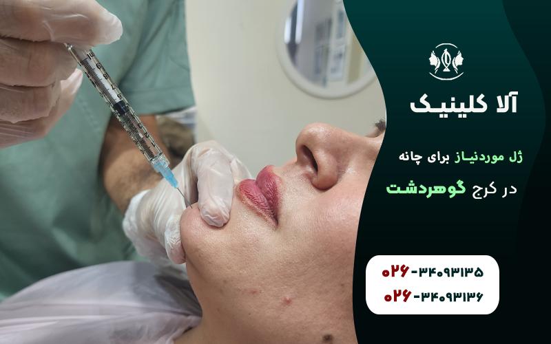 ژل موردنیاز برای چانه