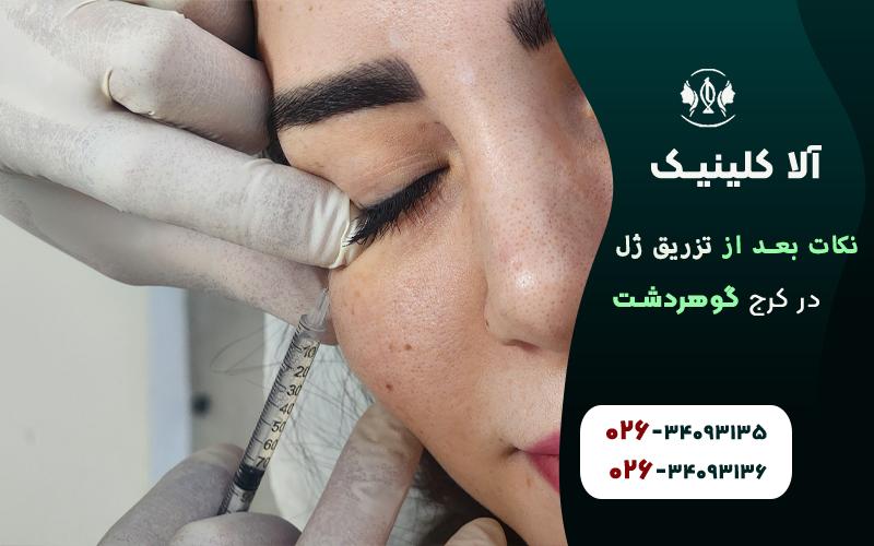 10نکته بعد از تزریق ژل که باید بدانید