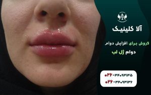 5روش برای افزایش دوام ژل لب