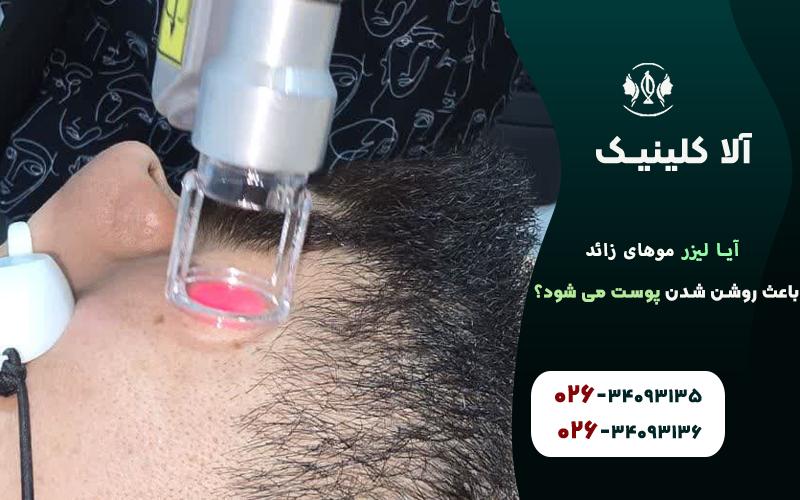 آیا لیزر موهای زائد باعث روشن شدن پوست می شود؟