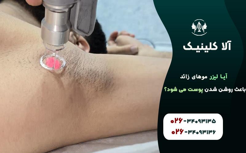 آیا لیزر موهای زائد باعث روشن شدن پوست می شود؟