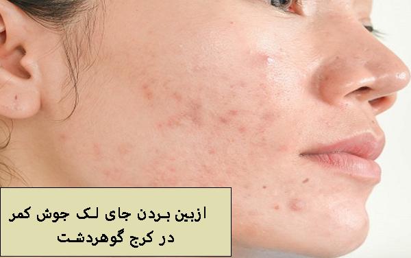 از بین بردن جای لک جوش کمر