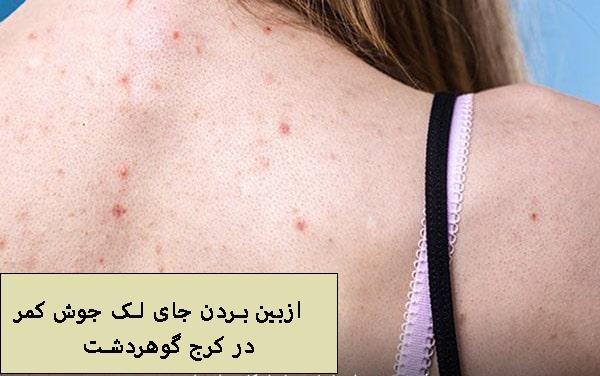 از بین بردن جای لک جوش کمر