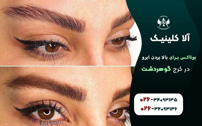 بوتاکس برای بالا بردن ابرو