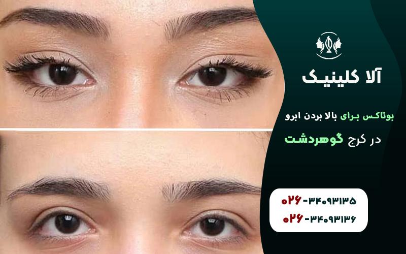 بوتاکس برای بالا بردن ابرو