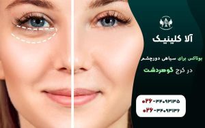 بوتاکس برای سیاهی دور چشم