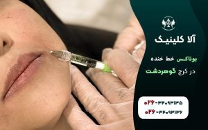 بوتاکس خط خنده در کرج