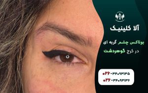 بوتاکس چشم گربه ای کرج