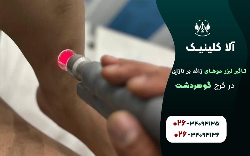 تاثیر لیزر موهای زائد بر نازایی