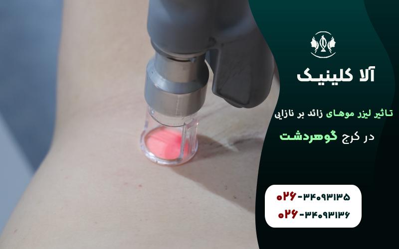 تاثیر لیزر موهای زائد بر نازایی