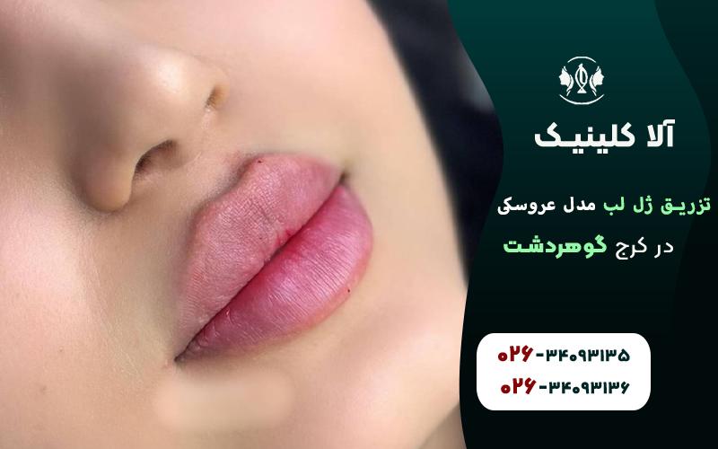تزریق ژل لب مدل عروسکی