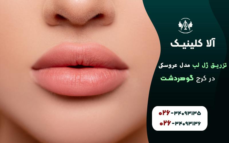 تزریق ژل لب مدل عروسکی