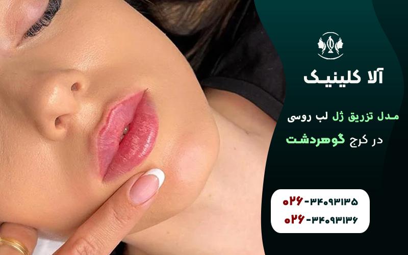 تصاویر مدل های تزریق ژل لب روسی