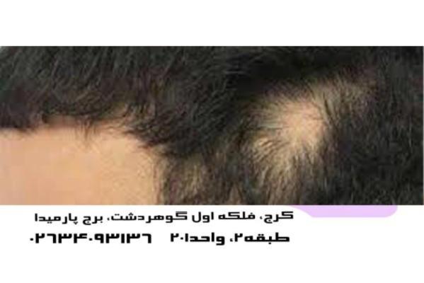 رویش مودر جای شکستگی