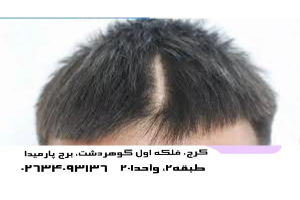 رویش مودر جای شکستگی