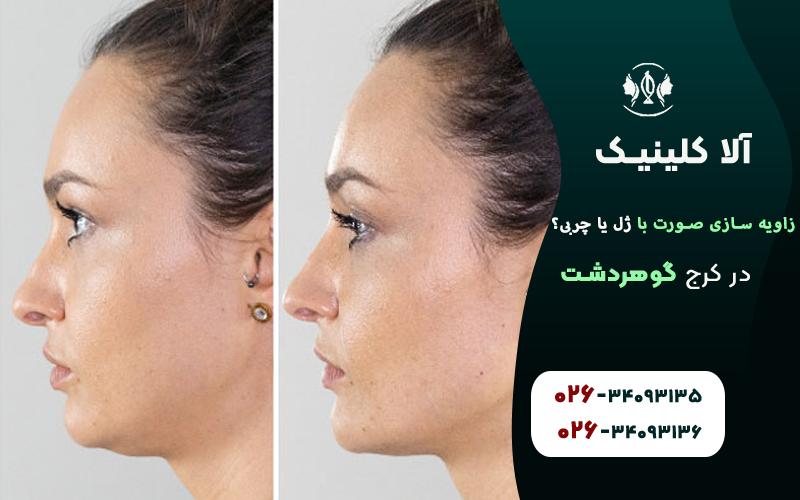 زاویه سازی صورت با ژل بهتر است یا چربی