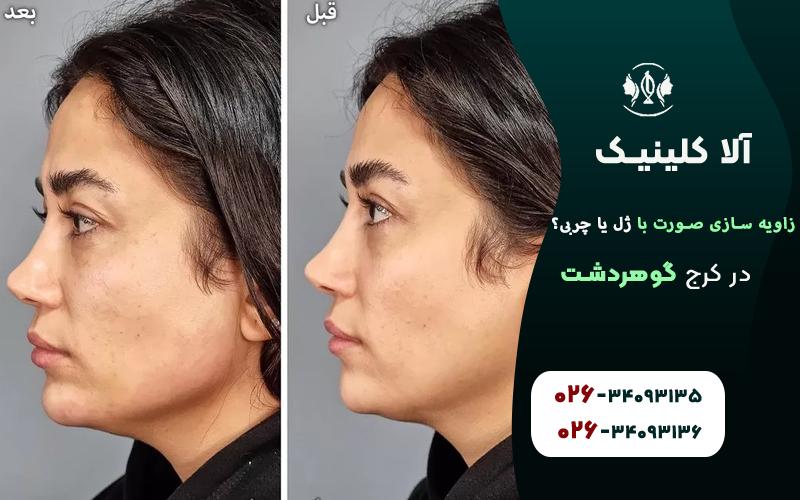 زاویه سازی صورت با ژل بهتر است یا چربی