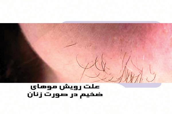 علت رویش موهای ضخیم در صورت زنان