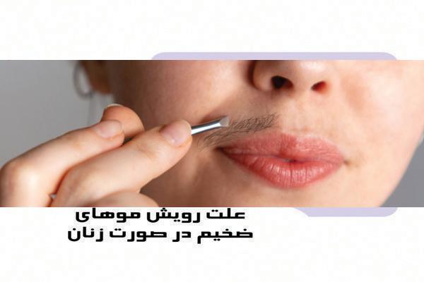 علت رویش موهای ضخیم در صورت زنان