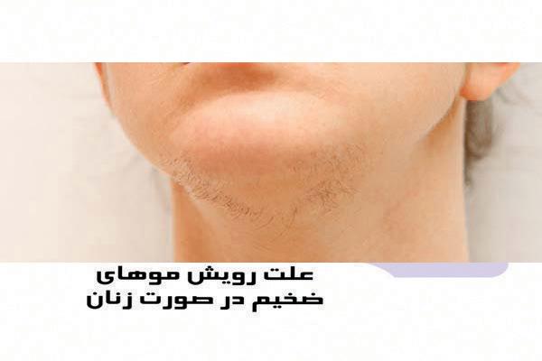 علت رویش موهای ضخیم در صورت زنان