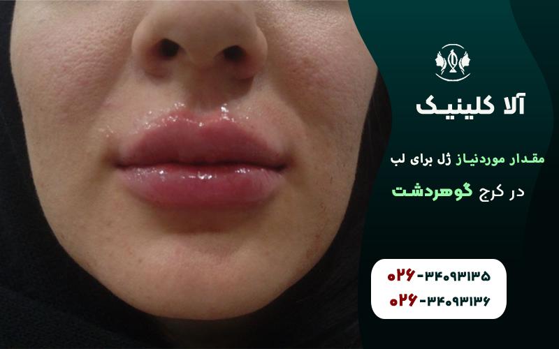 چند سی سی زل برای تزریق لب نیاز است