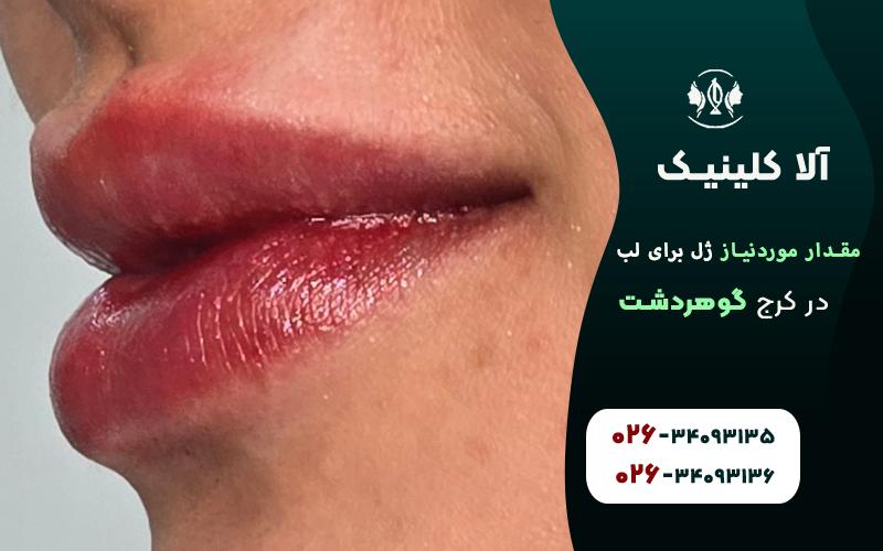 چند سی سی زل برای تزریق لب نیاز است