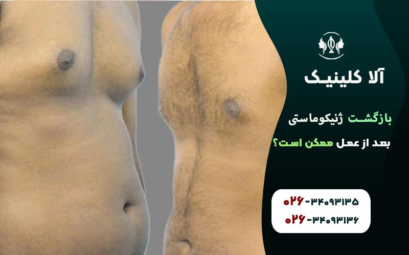 بازگشت ژنیکوماستی بعد از عمل ممکن است