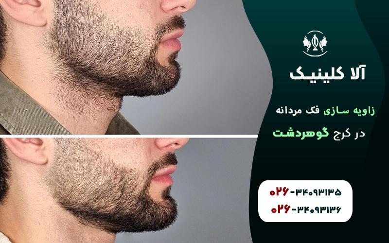 بهترین کلینیک زاویه سازی فک مردانه در کرج
