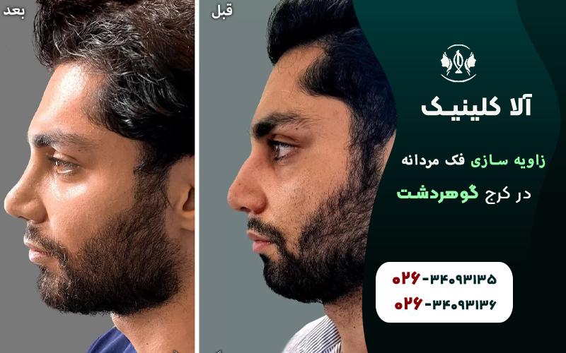 بهترین کلینیک زاویه سازی فک مردانه در کرج