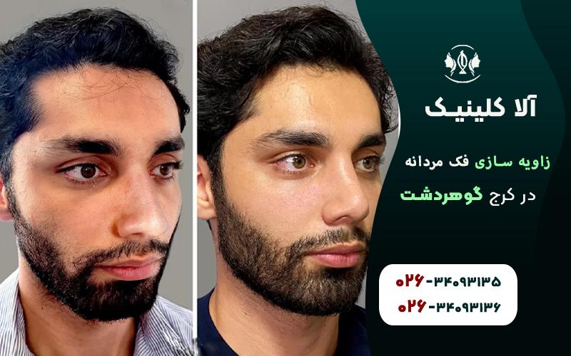 بهترین کلینیک زاویه سازی فک مردانه در کرج