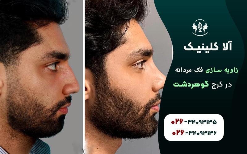 بهترین کلینیک زاویه سازی فک مردانه در کرج