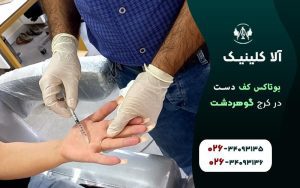 بوتاکس کف دست