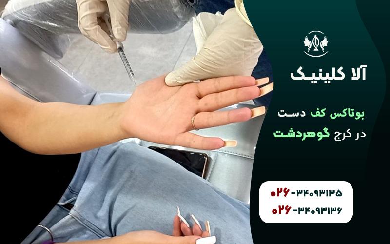 بوتاکس کف دست
