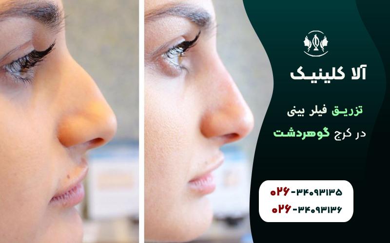 تزریق فیلر بینی در گوهردشت کرج