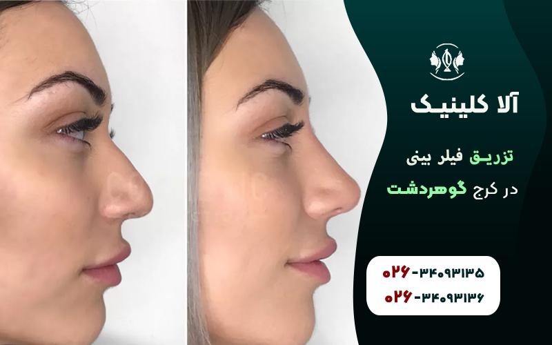 تزریق فیلر بینی در گوهردشت کرج
