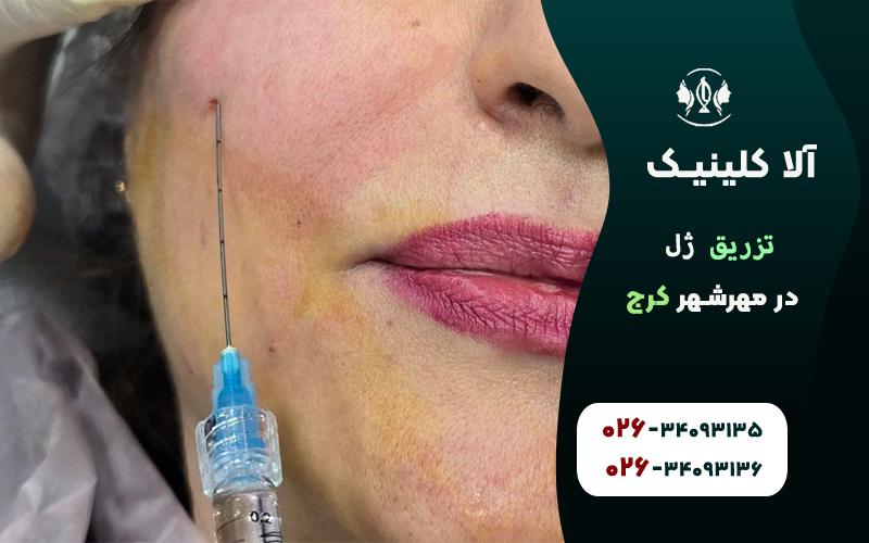 تزریق ژل در مهرشهر کرج