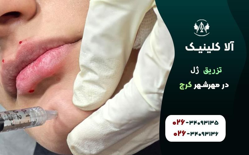 تزریق ژل در مهرشهر کرج، کجا خوبه